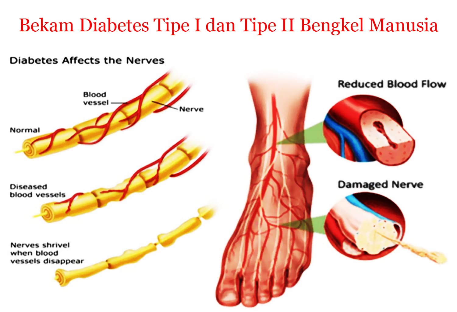 Bekam Batam Bekam Diabetes Tipe I dan II Bengkel Manusia