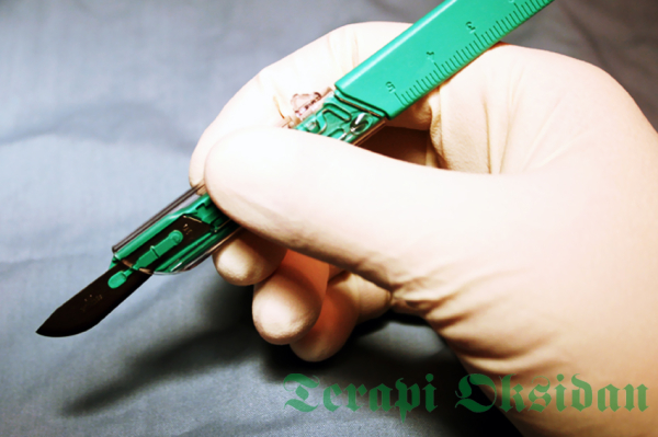 Bekam Jarum Menyelisihi Dalil Rasulullah