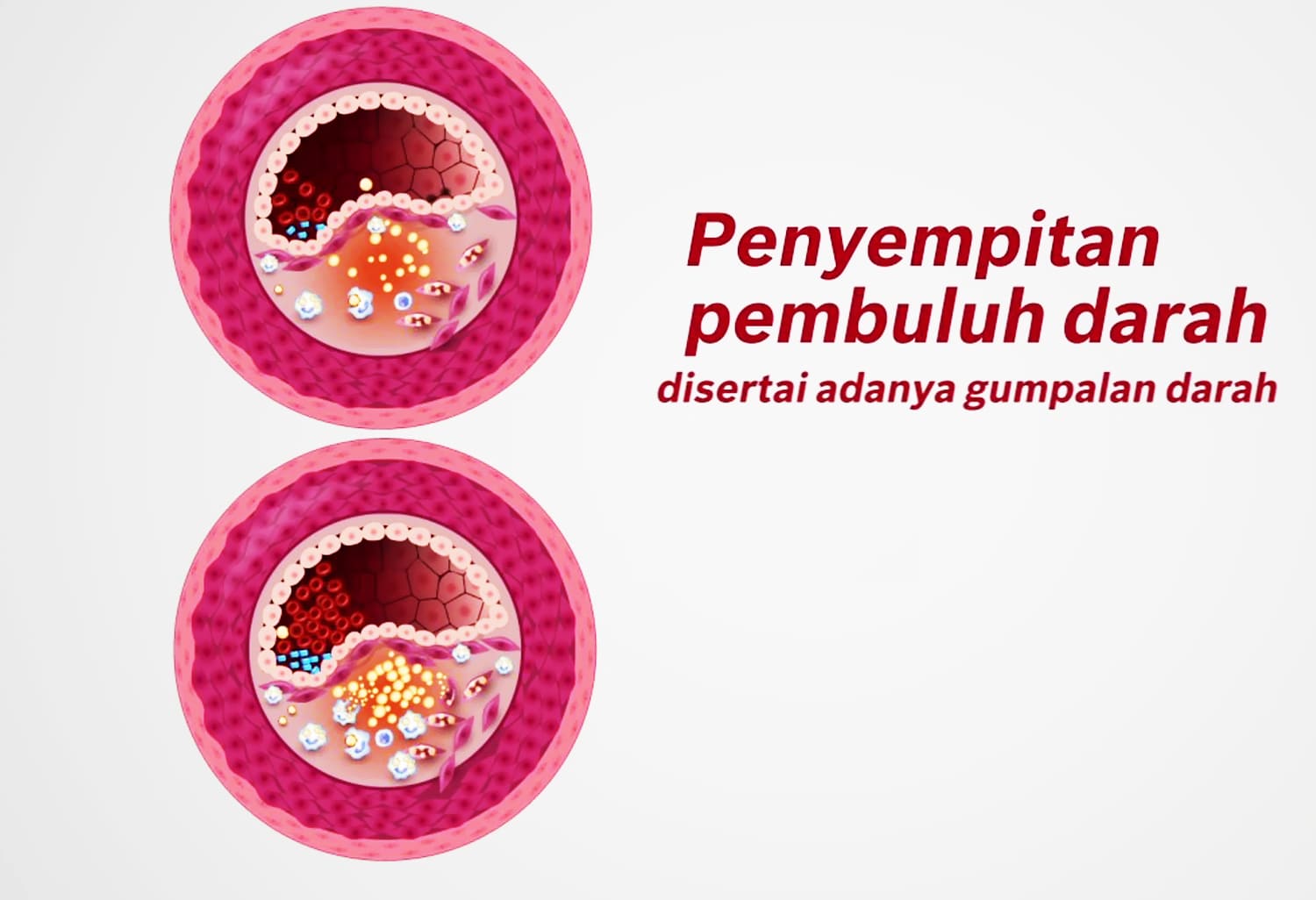 Bekam Batam Pengobatan Penyumbatan Pembuluh Darah