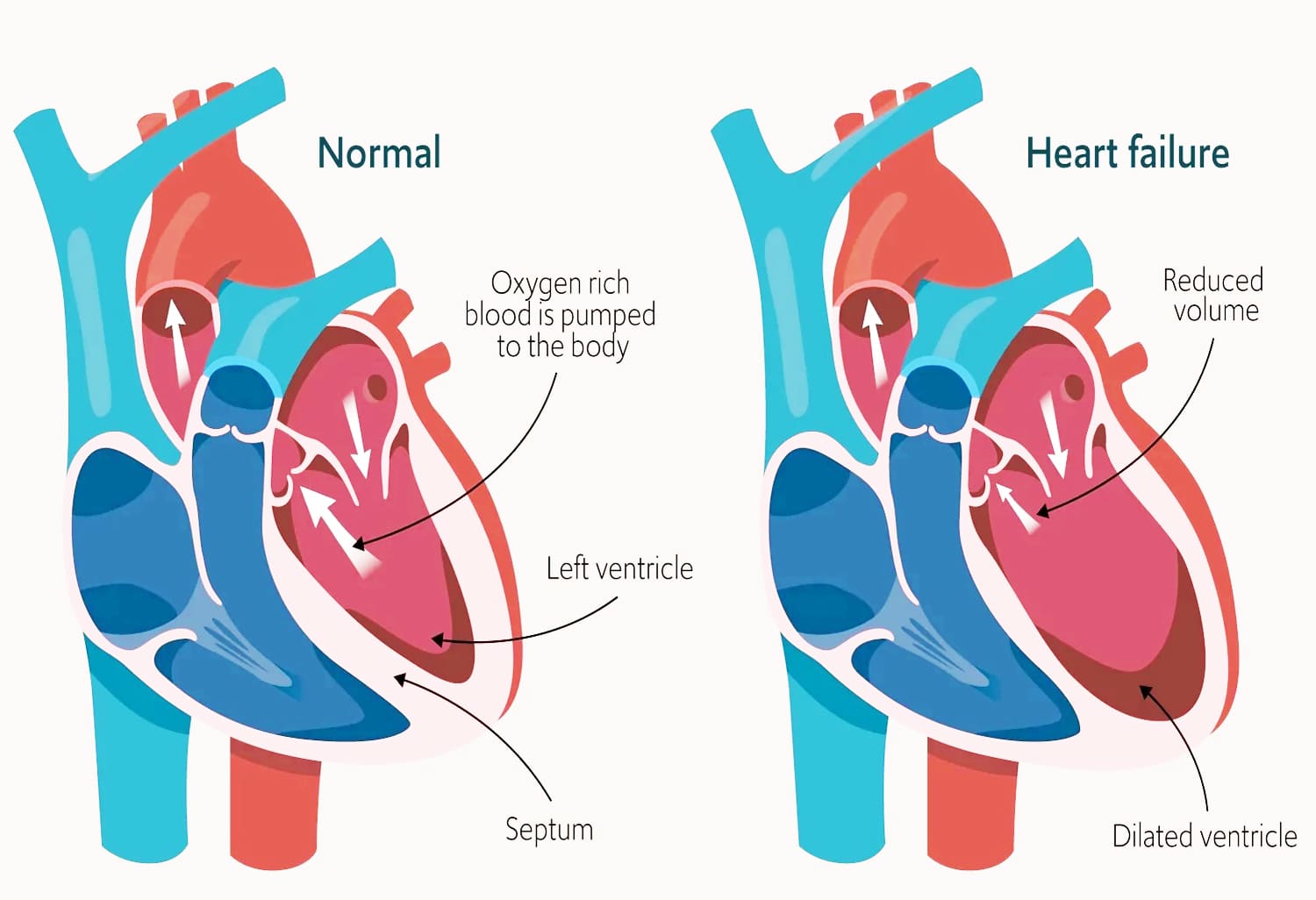 Heart Disorders Heal With Wet Cupping
