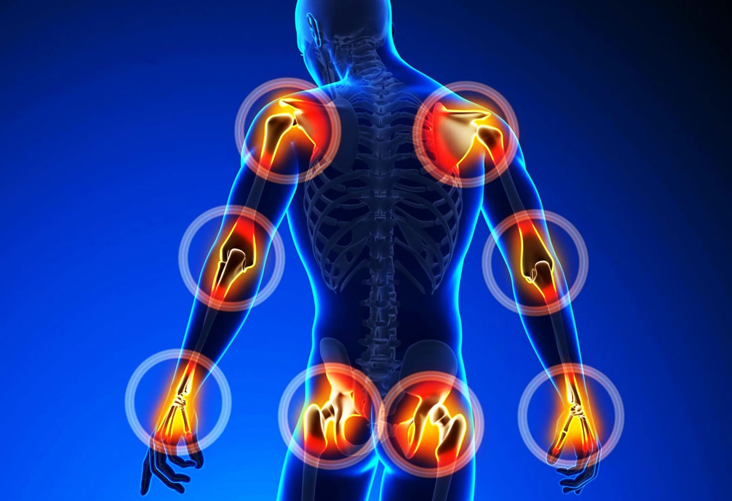 Manfaat Terapi Bekam untuk Nyeri Neuropatik Kronik