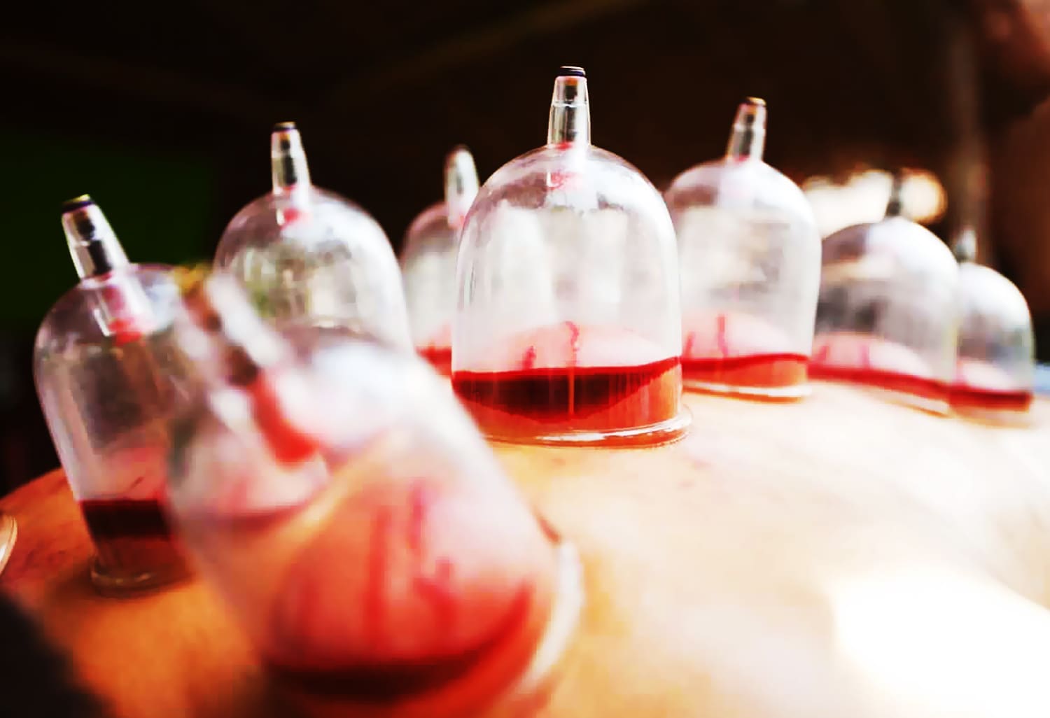 Wet Cupping Accelerates Pregnancy Study in Saudi Arabia Records 20 Percent of Patients Pregnant After Cupping