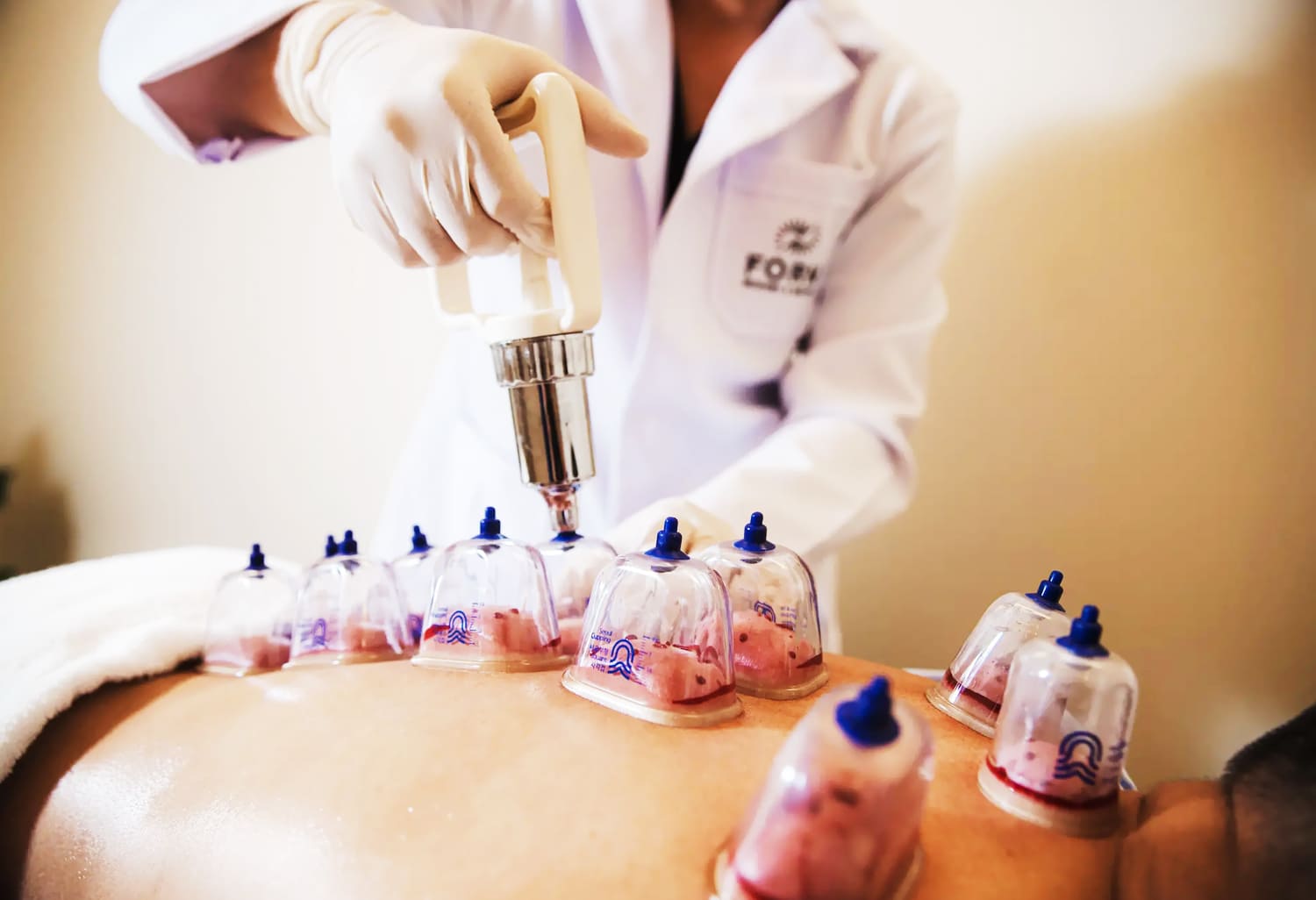 What Does Wet Cupping Therapy Do?