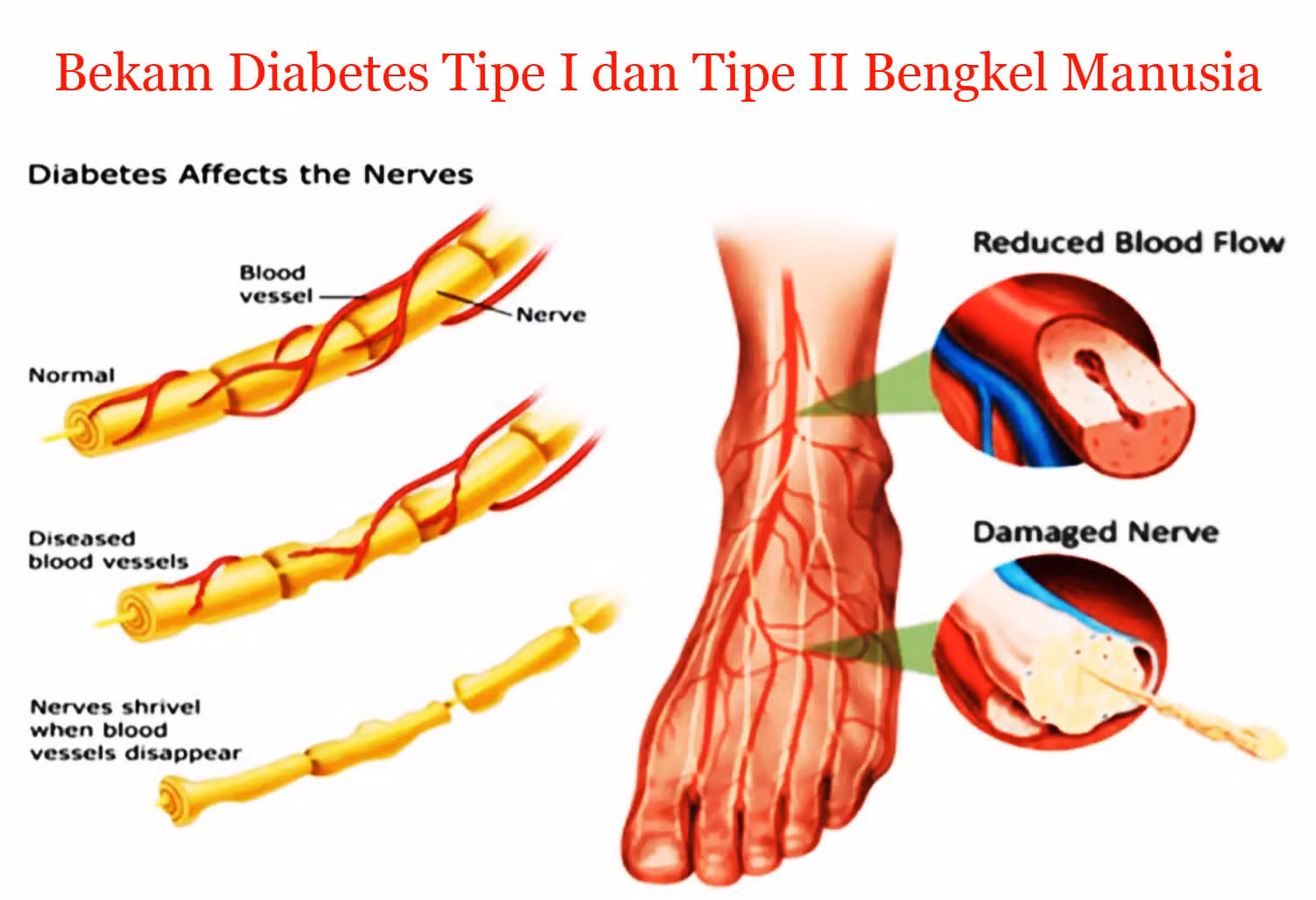 Bekam Batam Bekam Diabetes Tipe I dan II Bengkel Manusia