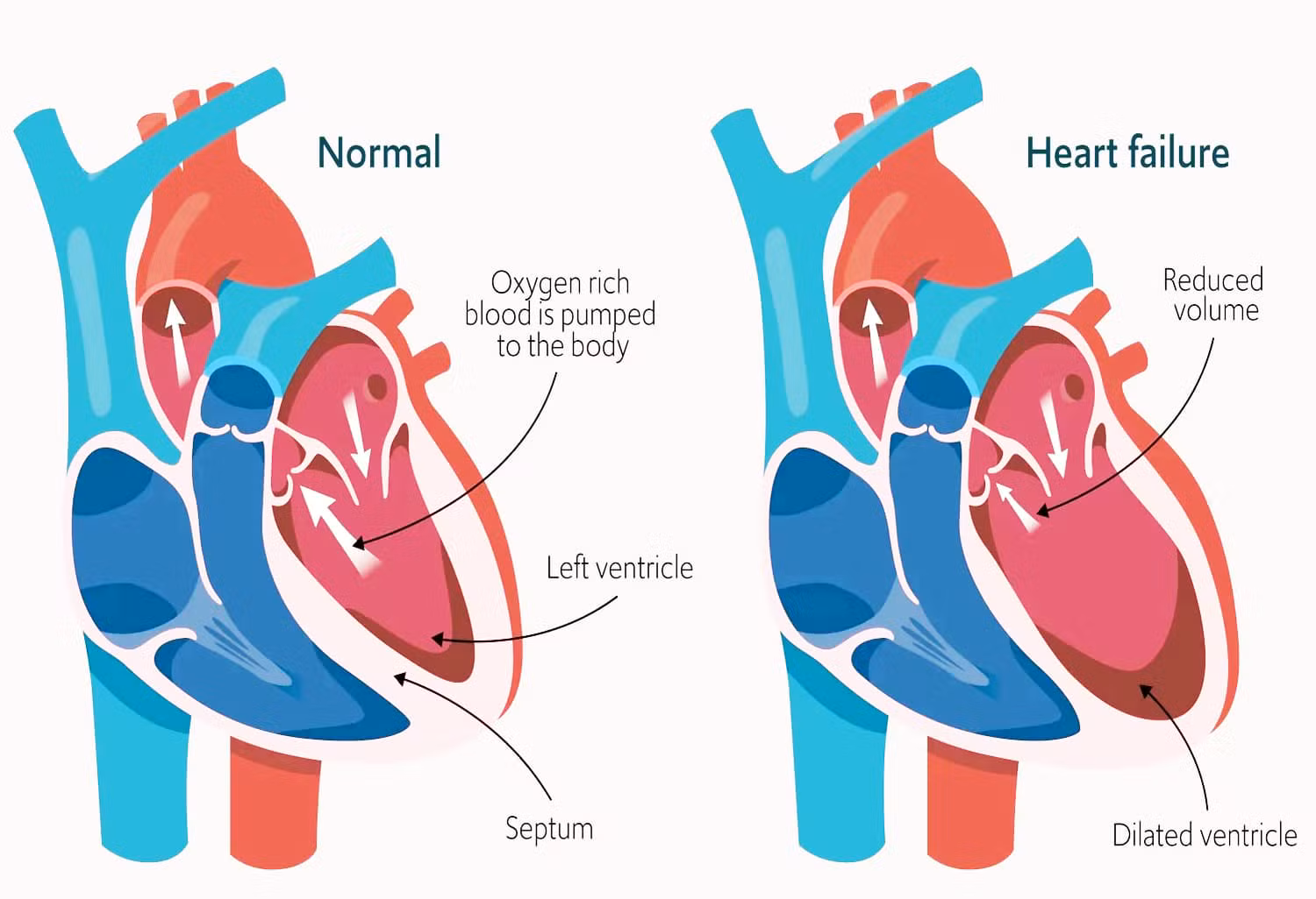Heart Disorders Heal With Wet Cupping