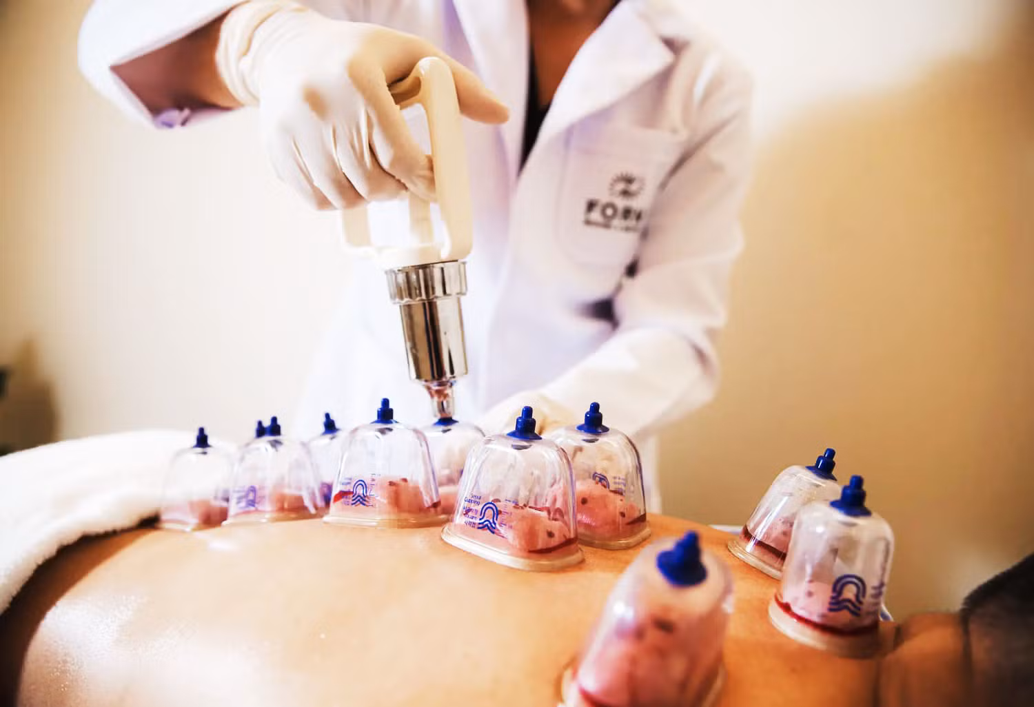 What Does Wet Cupping Therapy Do?