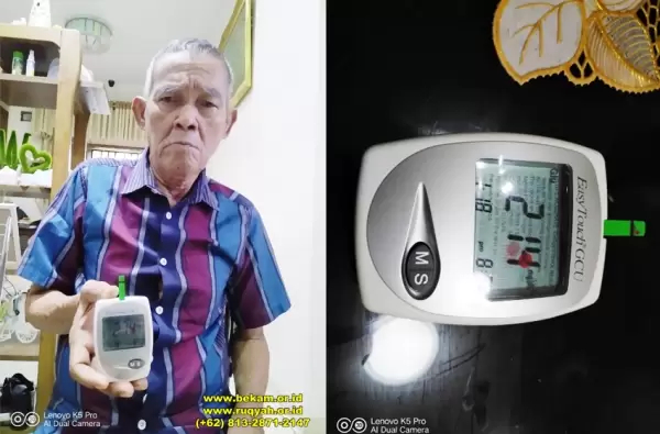 Pasien diabetes setelah diterapi bekam tidak jadi amputasi