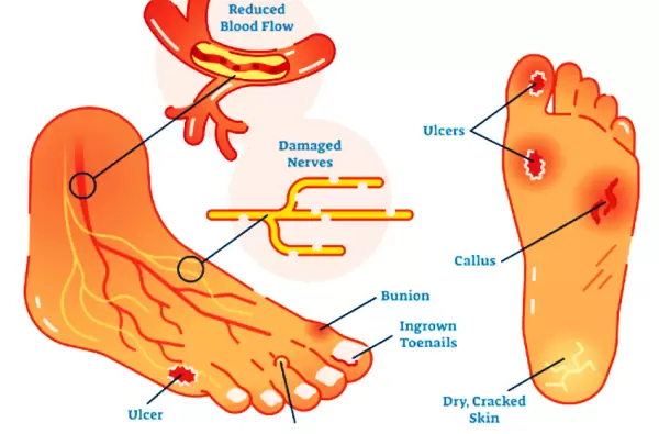 Bekam sangat mujarab untuk terapi diabetes tipe I dan tipe II