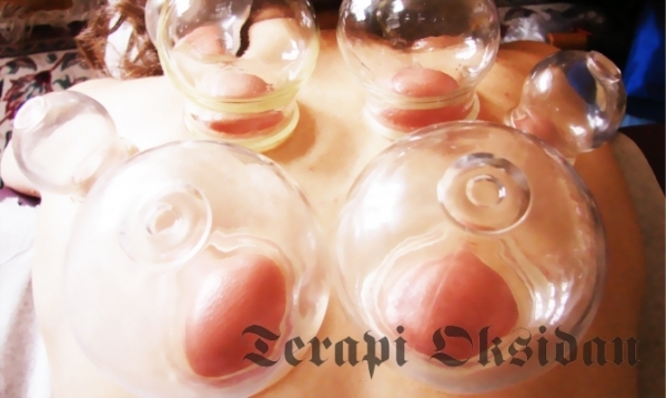 Bekam Bisa 'Menunda' Kematian, Mari Buktikan