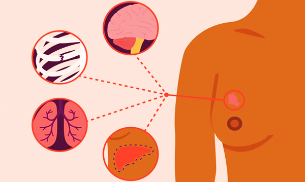 Kanker Berubah Hitam Setelah Dibekam