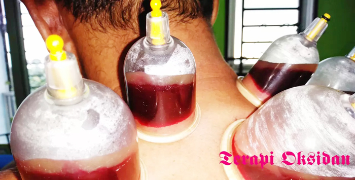 Bekam sembuhkan sakit migren